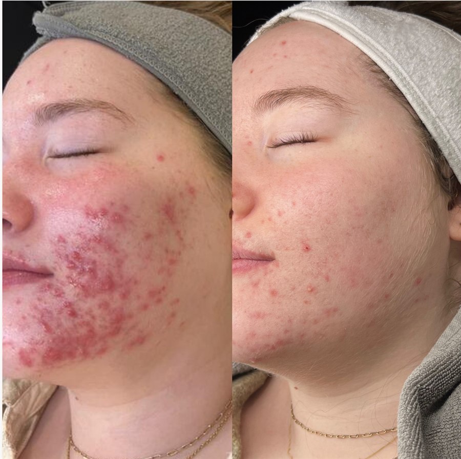 Before and after photographs of an Acne Programme client's cheek and jawline: widespread inflamed, cystic acne on the left, and substantially calmer, clearer skin on the right.