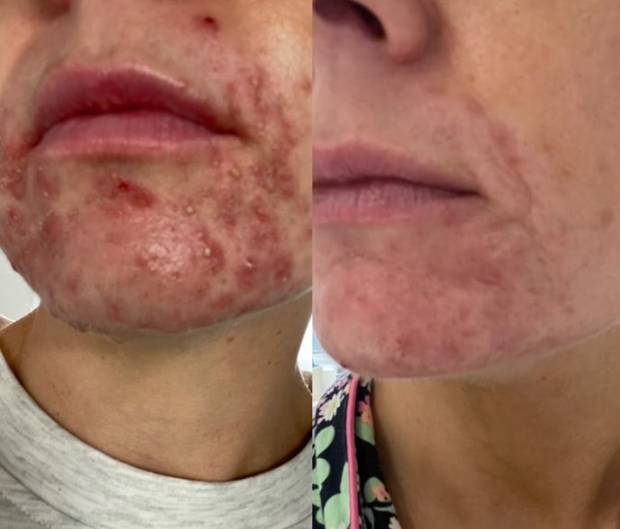 Before and after photographs of an Acne Programme client's chin and jawline: raised, inflamed breakouts on the left, and markedly settled skin on the right.