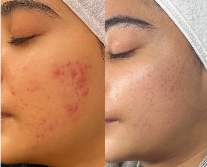 Before and after photographs of an Acne Programme client's cheek: a dense cluster of red, inflamed spots on the left, and far clearer skin with only faint marks remaining on the right.